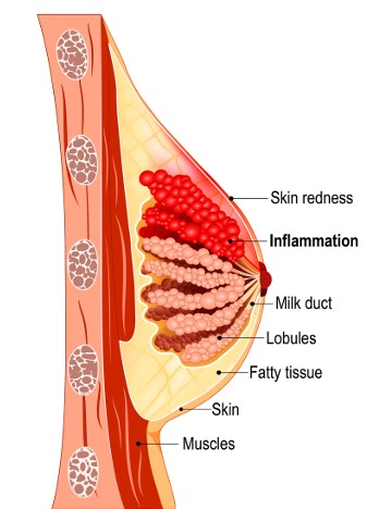 Image of milk ducts with showing how inflammation and skin redness can present.
